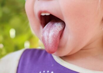 Чому виникає наліт на язику і як боротися з ним: ключові правила