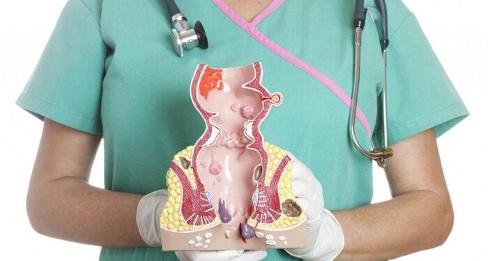 Як проводиться лікування геморою на початкових стадіях хвороби